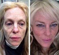 Vampire Facelift Before And After Photos (3)