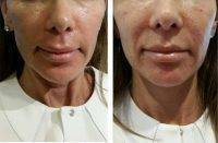 Vampire Facelift Before And After Photos (4)