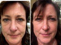 Vampire Facelift Before And After Pics (1)