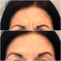 Vampire Facelift Before And After Pics (5)