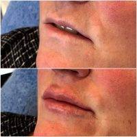 Vampire Facelift Before And Afters (2)