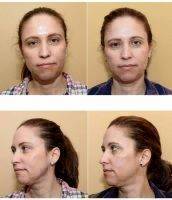 Vampire Facelift Before And Afters (3)