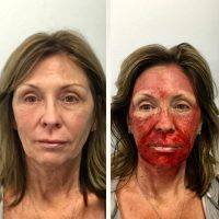 Vampire Facelift In Fort Lauderdale Before After