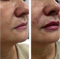 What Is Thermage Skin Tightening Photo