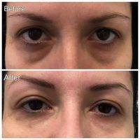 Wrinkle Treatment Around Eyes Before And After