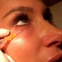 Wrinkle Treatment Injections