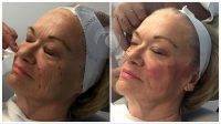 Wrinkle Treatment Injections Before And After