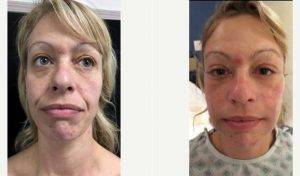 43 Year Old Woman Treated With Mini Facelift With Dr Martin Yanez, MD, Mexico Plastic Surgeon