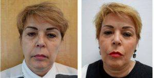 50 Year Old Woman Treated With Thread Lift To The Face And Neck Area Before And After By Dr Gerard Lambe, MBChB, MRCS, MDFRCS(Plast), Manchester Plastic Surgeon