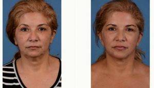 51 Year Old Woman Treated With Facelift, Neck Lift, Upper And Lower Blepharoplasty, And Chin Implant Before & After With Dr. David A. Sieber, MD, San Francisco General Surgeon