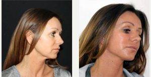 53 Year Old Woman Treated With Facelift Before And After With Doctor Amir Nakhdjevani, MBBS, MRCS, FRCS (Plast), London Plastic Surgeon