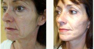 54 Year Old Woman Treated With Facelift Before And After By Doctor Gary L. Ross, MBChB, FRCS, Manchester Plastic Surgeon