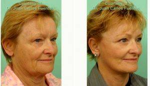 55 Year Old Woman Treated With Face And Neck Lift By Dr Juan Carlos Fuentes, MD, Mexico Plastic Surgeon