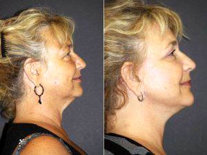57 Year Old Face Neck Lift Patient After Photos By Dr. Leonard Hochstein Before By Dr. Leonard Hochstein, MD, Miami Plastic Surgeon