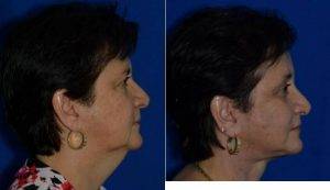 58 Year Old Man Treated With Facelift, Necklift, Platysmaplasty, Browlift, Upper Lower Lids With Doctor Eric Egozi, MD, Tampa Plastic Surgeon