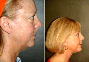 58 Years Old Female Treated For Facial Ritidosis By Doctor Ricardo Vega, MD, Mexico Plastic Surgeon