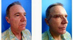 59 Year Old Man Treated With Facelift By Doctor Marco Carmona, MD, Mexico Plastic Surgeon