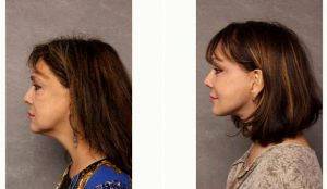 59 Year Old Woman Treated With Facelift By Doctor Christian G. Drehsen, MD, Tampa Plastic Surgeon