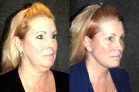 6 Weeks After A Deep Plane Facelift And Necklift By Dr Jacono