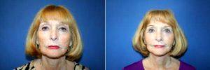 62 Year Old Female 10 Year After Primary Facelift. Secondary Facelift With AFT To Cheeks. Before With Dr. Glynn Bolitho, PhD, MD, FACS, San Diego Plastic Surgeon