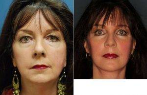 63 Year Old Woman Treated With Facelift Before And After By Doctor James C. Grotting, MD, FACS, Birmingham Plastic Surgeon