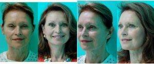 63 Year Old Woman Treated With Facelift Before And After With Dr Melanie L. Petro, MD, Birmingham Facial Plastic Surgeon
