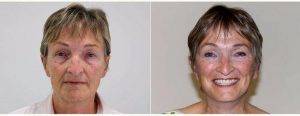 68 Year Old Woman Treated With Concept Facelift Before And After By Dr. Amir Nakhdjevani, MBBS, MRCS, FRCS (Plast), London Plastic Surgeon