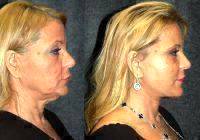 A Minimal Incision Deep Plane Facelift, Fattransfer And Lower Eyelift