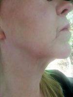 A Neck Lift, Or Lower Rhytidectomy