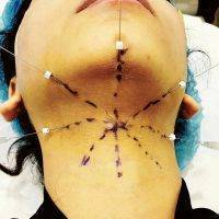 A Suture Suspension Face Lift