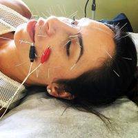 Acupuncture Facelift Tampa