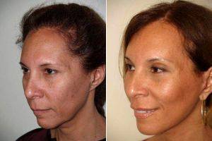 And Just 2months After Extended Midfacelift And Browlift Before With Doctor Jeffrey Epstein, MD, FACS, Miami Facial Plastic Surgeon