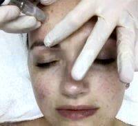 BOTOX Injection Cost Can Vary Greatly