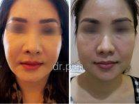 Before And After BOTOX Injection