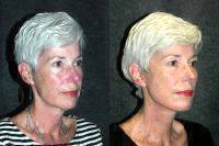 Before And After Deep Plane Facelift With Fractional CO2 Laserresurfacing