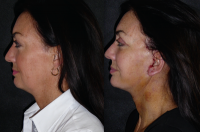 Before And After Half Face Lift By Doctor Roger J. Oldham