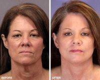 jowls facelift after before surgery sagging prices info reviews