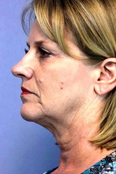 Before And After Lifestyle Lift (4) » Facelift: Info ...