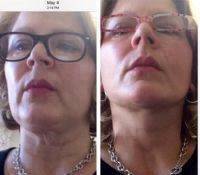 Before And After Lower Facelift And Neck Lift Photos