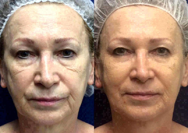 Before And After Micro Current Facial Toning Facelift Info Prices Photos Reviews Qanda