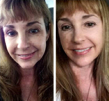 Before And After Mini Facelift In Philippines » Facelift: Info, Prices ...