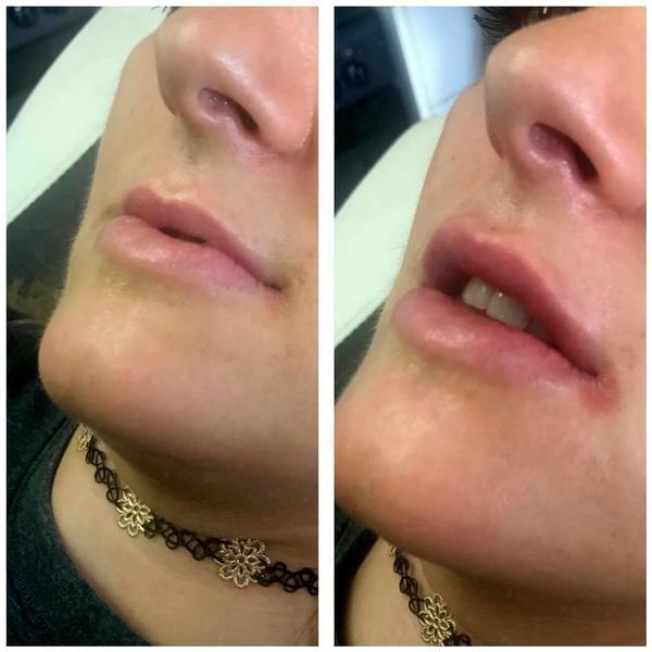 Botox Before And After Lip Injection Facelift Info Prices Photos Reviews Q A