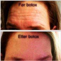 Botox Before And After Pics Forehead (1)
