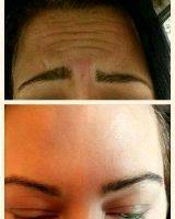 Botox Before And After Pics Forehead (11)