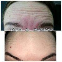 Botox Before And After Pics Forehead (3)