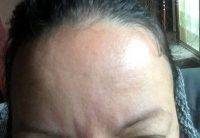 Botox Before And After Pics Forehead (6)