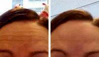 Botox Before And After Pics Forehead (7)