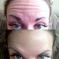 Botox Before And After Pics Forehead (8)