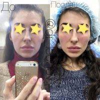Botox Before And After Pictures (1)