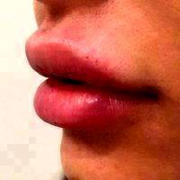 Botox Filler Lips